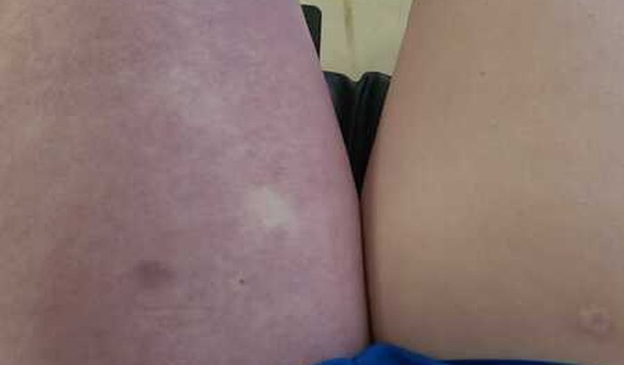 Trombose Venosa Profunda Aline 