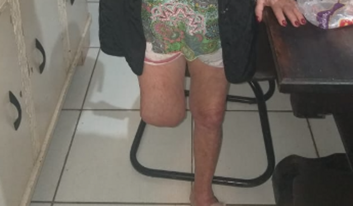 Prótese para perna - Nilza