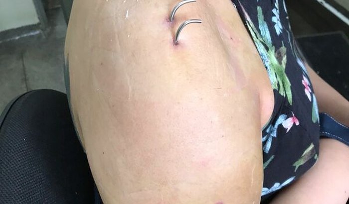 ME AJUDE A FAZER A CIRURGIA DO ÚMERO PARA QUE EU NÃO TENHA QUE COLOCAR PRÓTESE