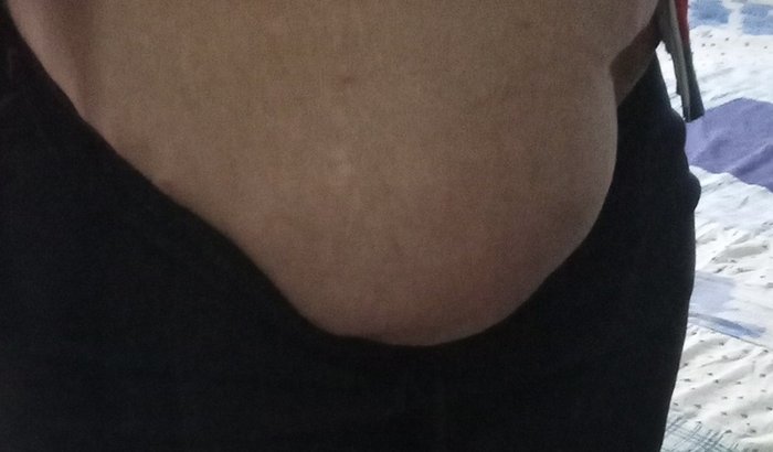 Ajuda para realizar cirurgia de hernia crescendo