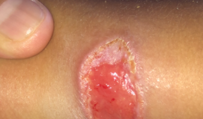 Arthur leishmaniose tegumentar