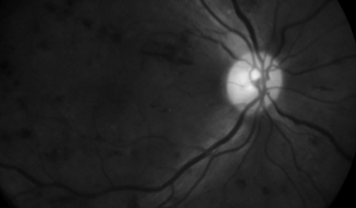 Ajuda para tratamento médico de Andréa Ramires do HUMAP - Maternidade