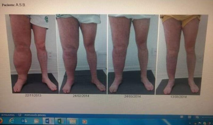 Cirurgia de linfedema