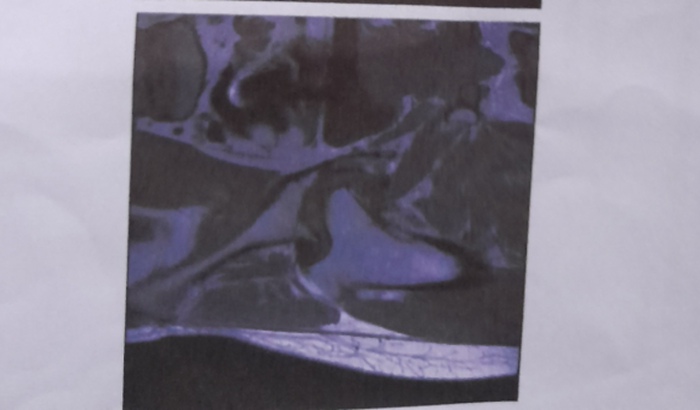 Cirurgia de protese de fêmur