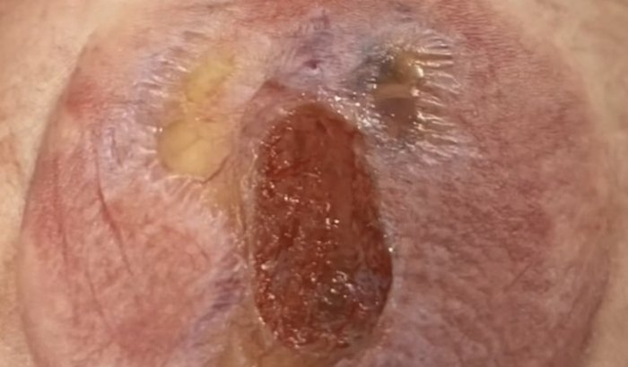 Mielomeningocele do Arthur