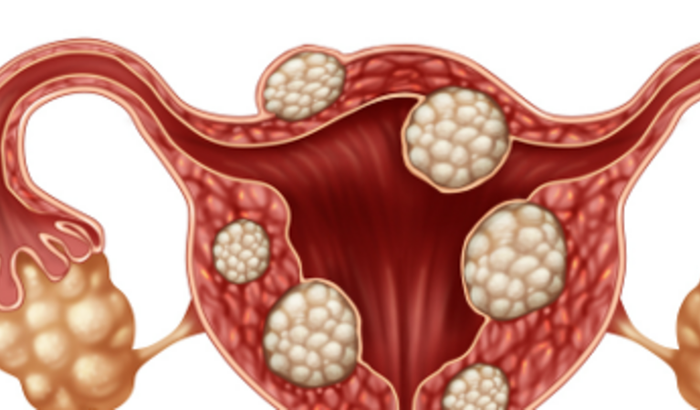 Cirurgia Miomectomia