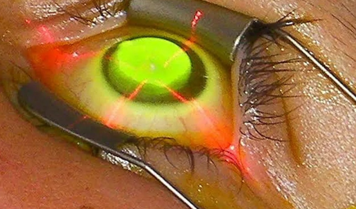 Ajude com a cirugia CERATOCONE do jovem Kauã 🙌 