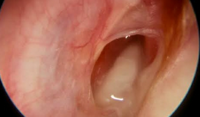 AJUDE AO DIONE A FAZER TÍMPANO PLASTIA 