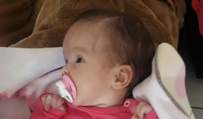 Cirurgia de Hidrocefalia da Alice