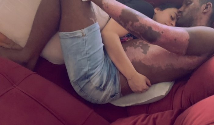 está em tratamento para queimadura de segundo e terceiro grau 