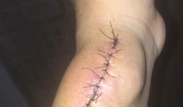 Tratamento hemodialise , fora da minha cidade