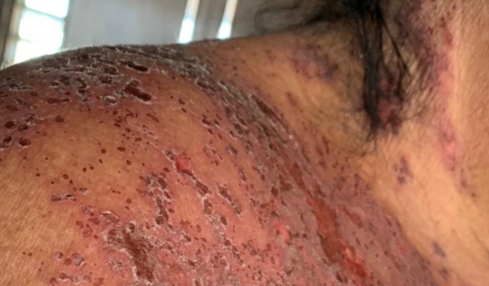 Vacina para Herpes Zóster