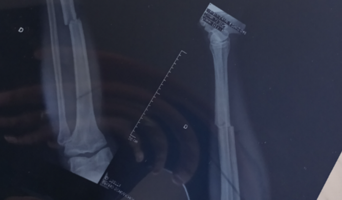 Cirurgia para correção e calcificação óssea "tíbia"