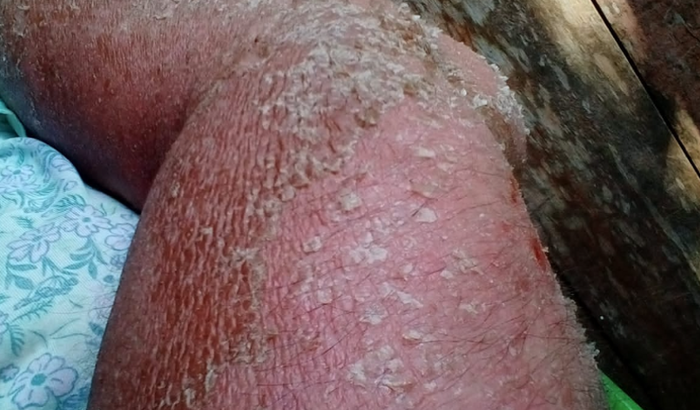 Otaciane precisa realizar exames, pois possui psoríase.