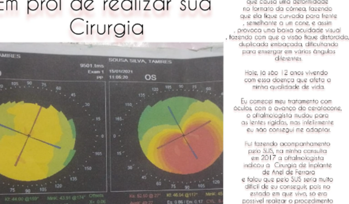 Preciso Cirurgia do olho 
