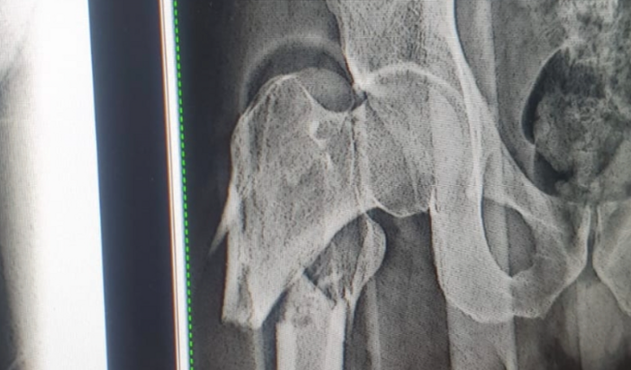 Cirurgia de fêmur (Weber)