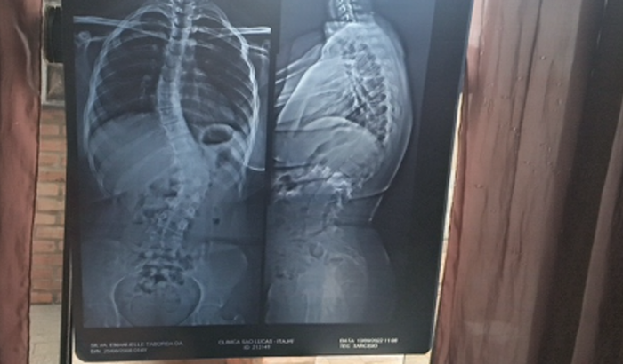 Ajuda para Tratamento de Escoliose Grave!