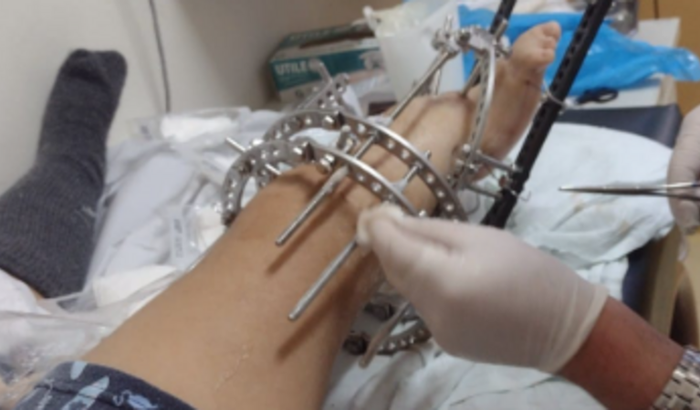 Infeccao perninha Vitor Hugo Novo Horizonte SP