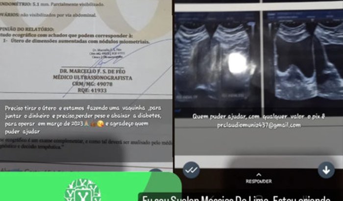 Ajuda para cirurgia ROSEMARY 