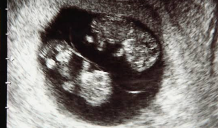 Ajuda para ressonância dos gêmeos  da marcia