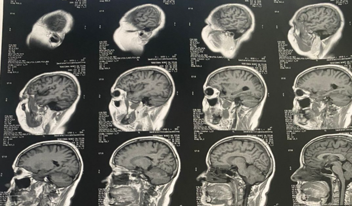 Ajuda para Cirurgia de Tumor Cerebral - Ajude Terezinha