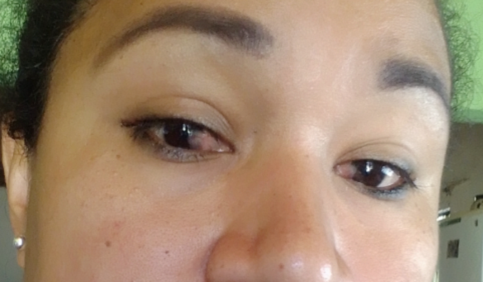 Cirurgia dos olhos da Ana manicure