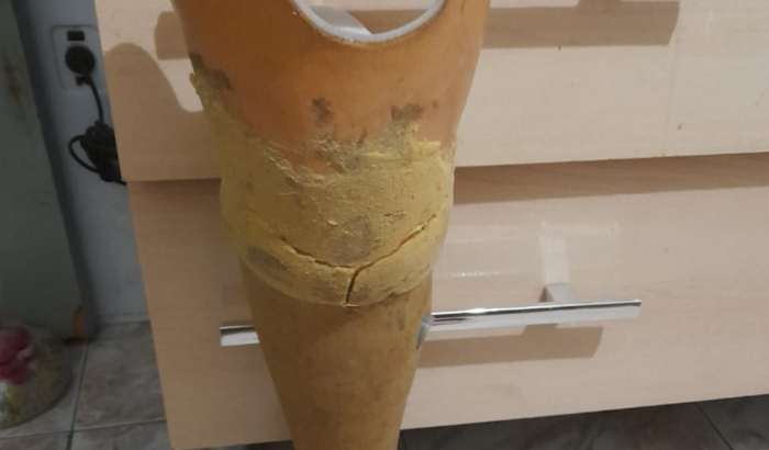 Ajuda para comprar uma prótese de perna para minha mãe 