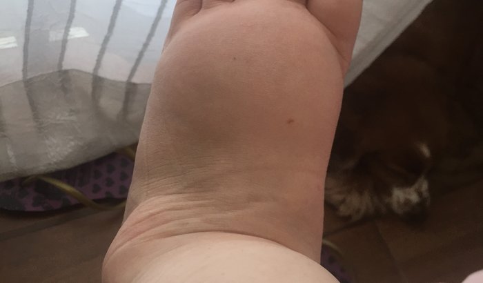 Tratamento do meu Linfedema