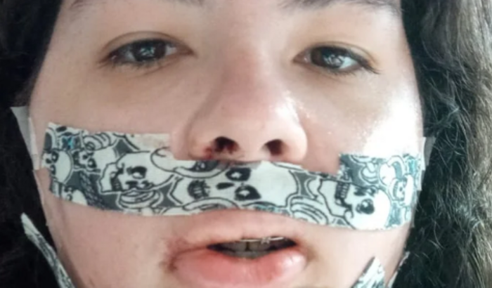 Tratamento pós operatório da face.