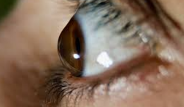 Cirurgia de Ceratocone 