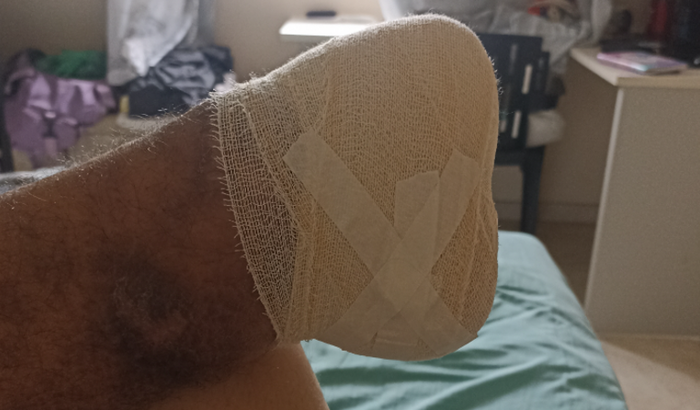 Prótese do pé esquerdo 