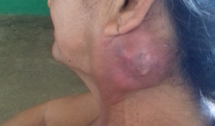 Precisamos de uma quantia em dinheiro para o tratamento de quimioterapia de minha tia