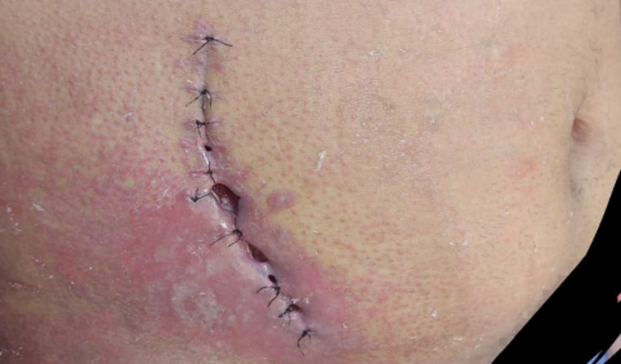 Tratamento do Leandro de Jesus