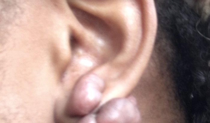 Minha cirurgia na orelha