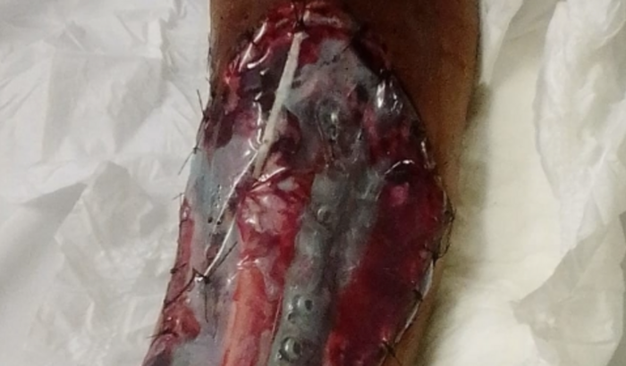 Cirurgia da minha vó ( Maura)