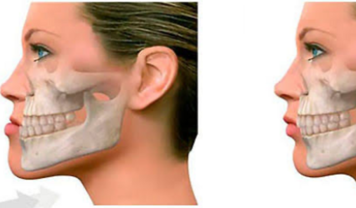 Cirugia ortognática