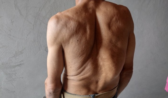 Cirurgia da coluna por escoliose lombar grave 