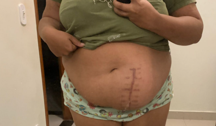 Ajude a Juliana - CIRURGIA DE HÉRNIA INCISIONAL