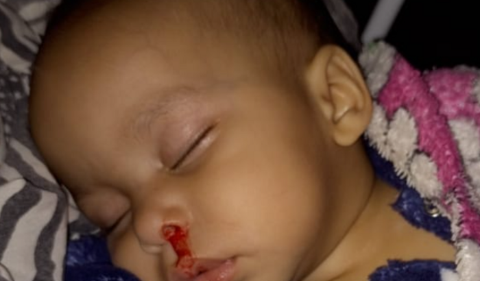 Tratamento da Ana Vitória