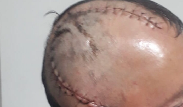 Refazer a cirurgia do meu filho com um tumor cerebral .