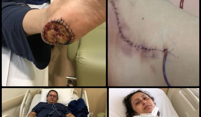 AJUDE ISABEL - Medicamento para tratamento de câncer: PENBROLIZUMABE (KEYTRUDA) 400mg IV a cada 6 semanas por 1 ano