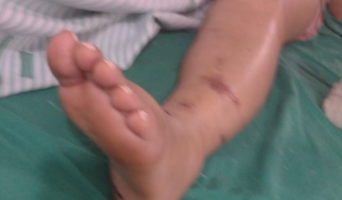 Cirurgia de fratura total de tíbia e fíbula.