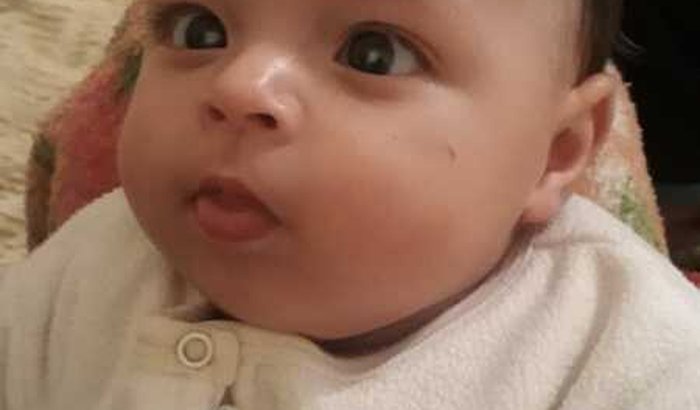 Cirurgia de catarata congênita do gael