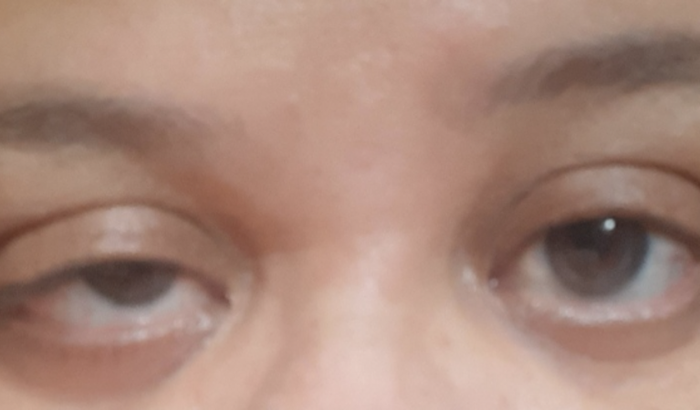 Se puder ajudar a comprar a lente Rígida ou Escleral 