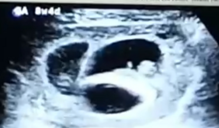 Enoxoparina/ Gravidez de trigêmeos 