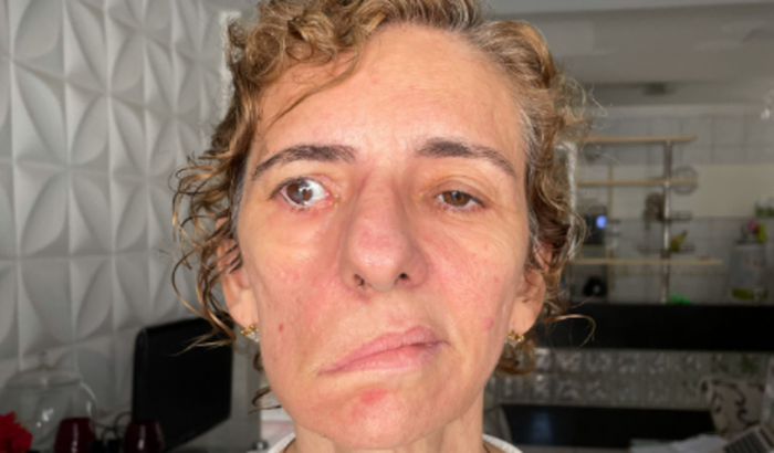 Ajuda Carmem Queiroz no tratamento de uma paralisia facial decorrente de um tumor cerebral.