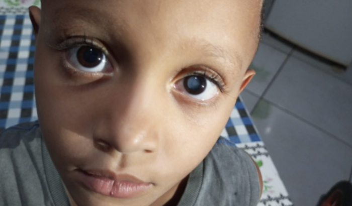 Cirurgia ocular do pequeno Vitor Emanuel