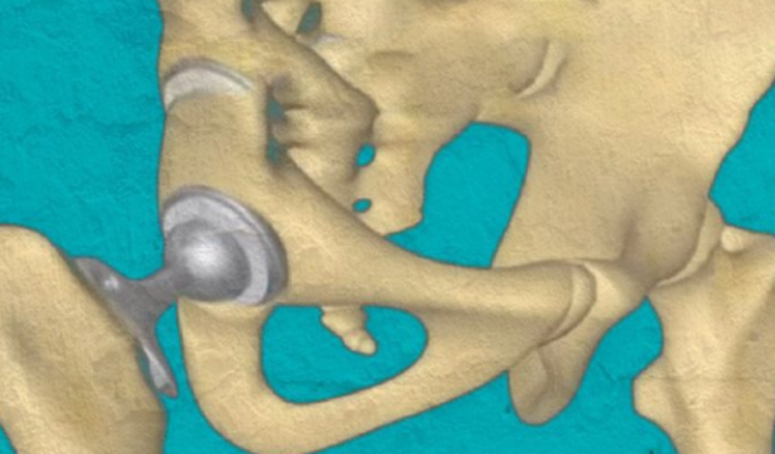 Preciso de uma ajuda para compra e cirurgia do membro inferior coxo-femoral para voltar a andar sem ajuda de muleta 