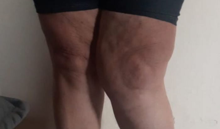 Artoplastia total do joelho esquerdo.