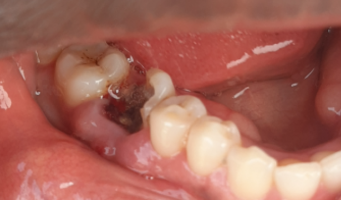Inserção e implante dentário 